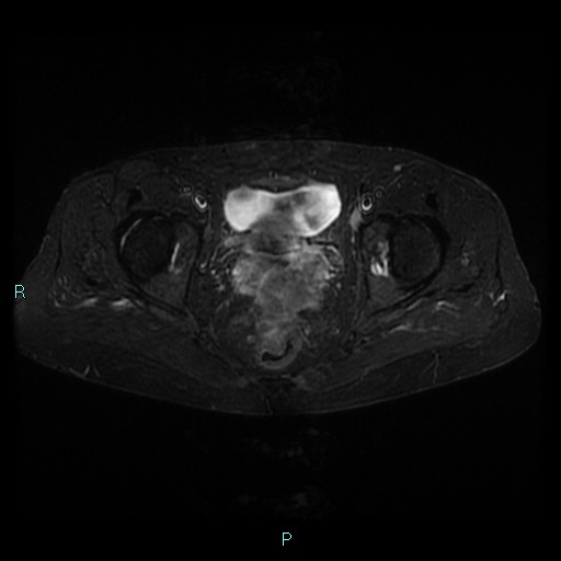 File:Bilateral ovarian fibroma (Radiopaedia 44568-48293 Axial STIR 19).jpg