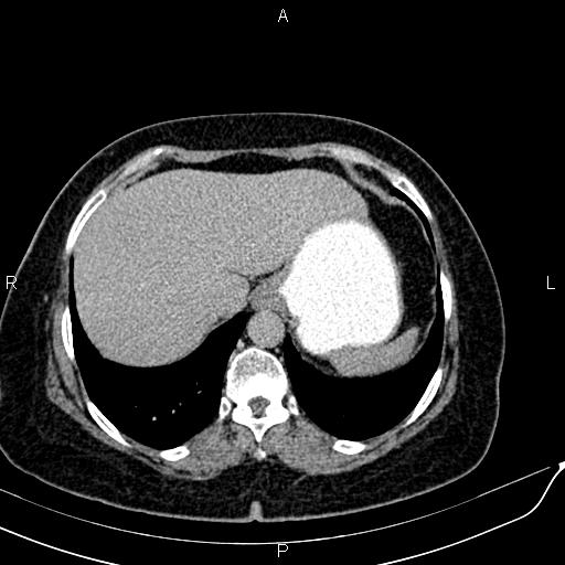File:Bilateral ovarian serous cystadenocarcinoma (Radiopaedia 86062-101989 Axial C+ delayed 2).jpg