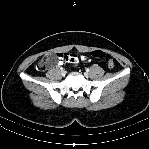 Bilateral ovarian teratoma (Radiopaedia 83131-97503 Axial With contrast 20).jpg