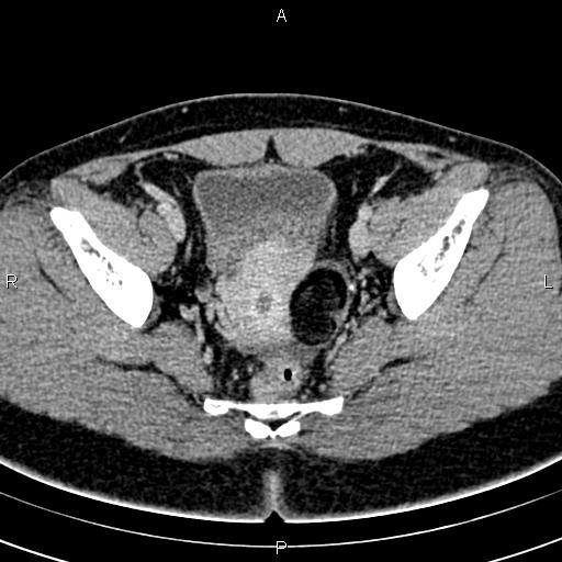 Bilateral ovarian teratoma (Radiopaedia 83131-97503 B 47).jpg