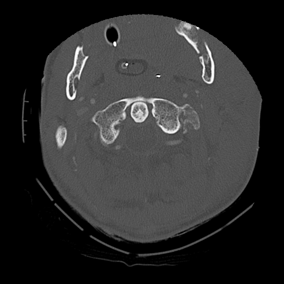 File:Bilateral perched facets with cord injury (Radiopaedia 45587-49713 Axial bone window 27).jpg