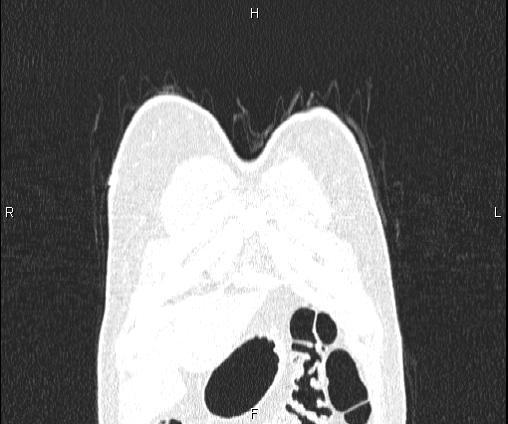 Bilateral pulmonary AVM (Radiopaedia 83134-97505 Coronal lung window 12).jpg