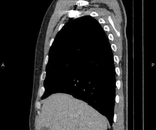 Bilateral pulmonary AVM (Radiopaedia 83134-97505 D 34).jpg