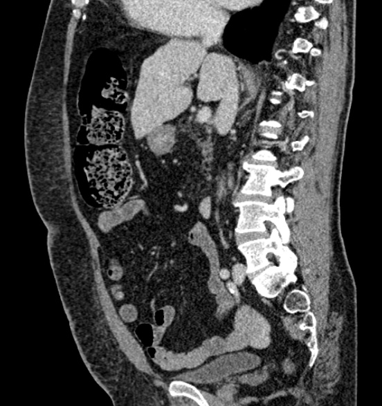 File:Bilateral rectus sheath hematomas (Radiopaedia 50778-56252 B 37).jpg