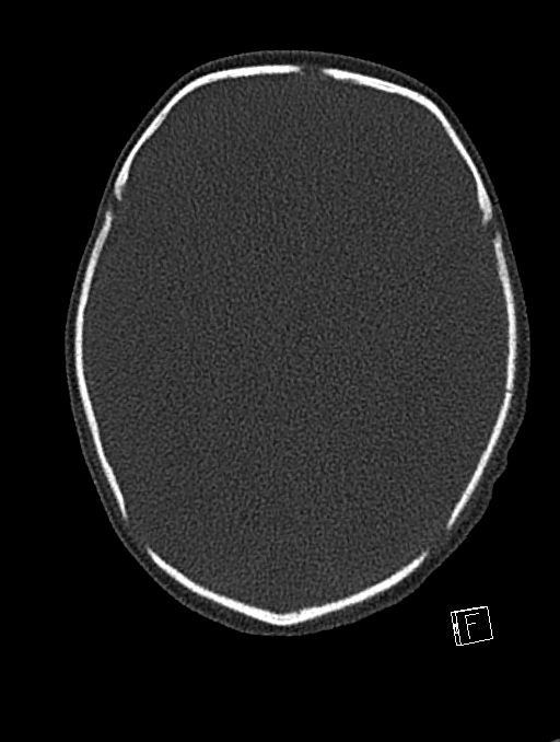 Bilateral subdural hemorrhage and parietal skull fracture (Radiopaedia 26058-26192 Axial bone window 75).png