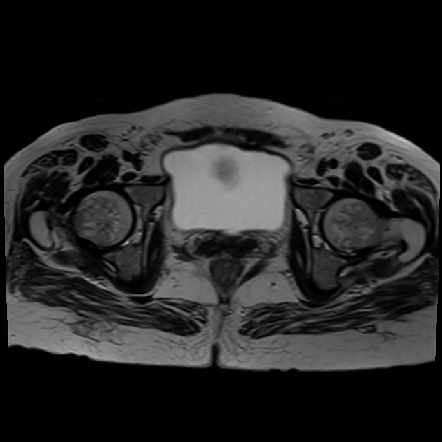 Bilateral tubo-ovarian abscesses (Radiopaedia 58635-65829 Axial T2 36).jpg
