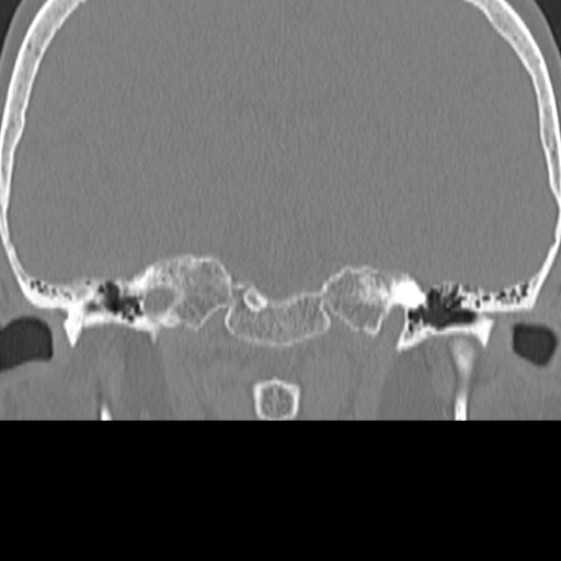 File:Bilateral tympanoplasty (Radiopaedia 16947-16664 Coronal bone window 6).jpg