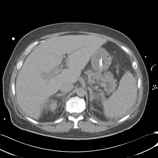 Bladder rupture post renal biopsy (Radiopaedia 30863-31572 Axial non-contrast 25).jpg