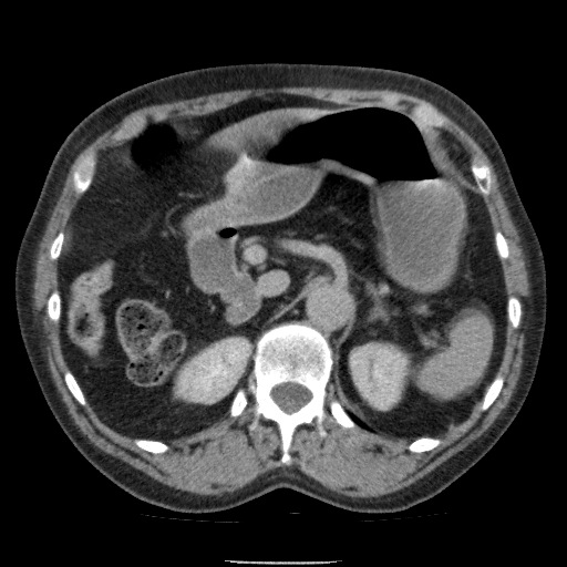 Bladder tumor detected on trauma CT (Radiopaedia 51809-57609 C 41).jpg