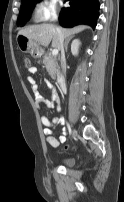 Bleeding duodenal ulcer and adenomyomatosis of gallbladder (Radiopaedia 61834-69861 C 42).jpg