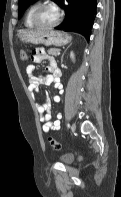 Bleeding duodenal ulcer and adenomyomatosis of gallbladder (Radiopaedia 61834-69861 C 63).jpg