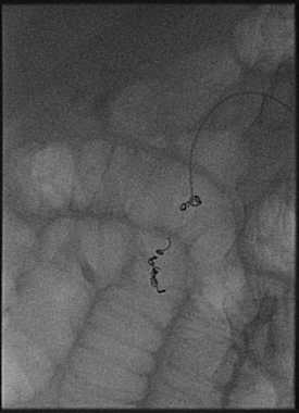 File:Bleeding duodenal ulcer and adenomyomatosis of gallbladder (Radiopaedia 61834-69863 Frontal 16).jpg