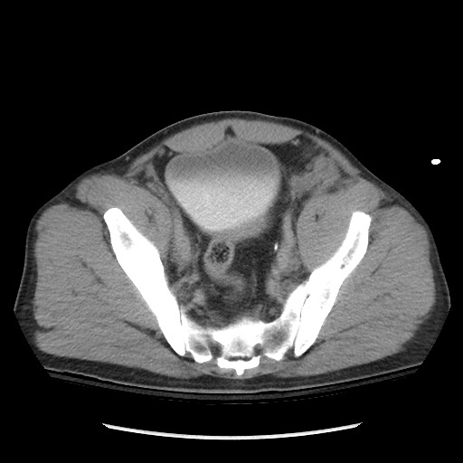 Blunt abdominal trauma with solid organ and musculoskelatal injury with active extravasation (Radiopaedia 68364-77895 Axial C+ delayed 115).jpg