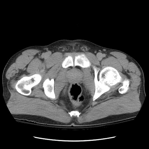 File:Blunt abdominal trauma with solid organ and musculoskelatal injury with active extravasation (Radiopaedia 68364-77895 Axial C+ delayed 136).jpg