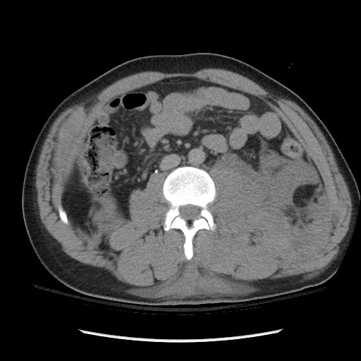 Blunt abdominal trauma with solid organ and musculoskelatal injury with active extravasation (Radiopaedia 68364-77895 Axial C+ delayed 73).jpg