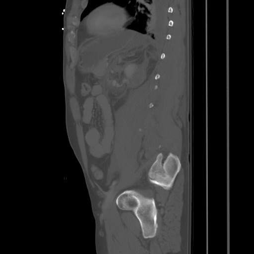 Blunt abdominal trauma with solid organ and musculoskelatal injury with active extravasation (Radiopaedia 68364-77895 Sagittal bone window 72).jpg