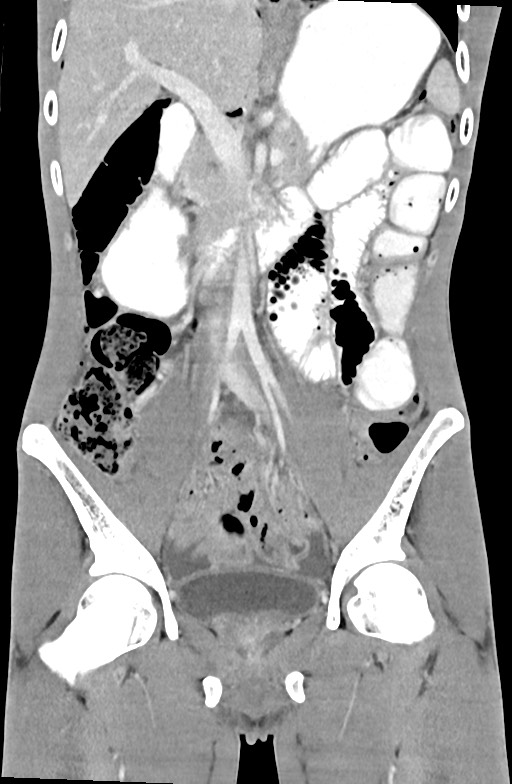 Blunt injury to the small bowel (Radiopaedia 74953-85987 B 46).jpg