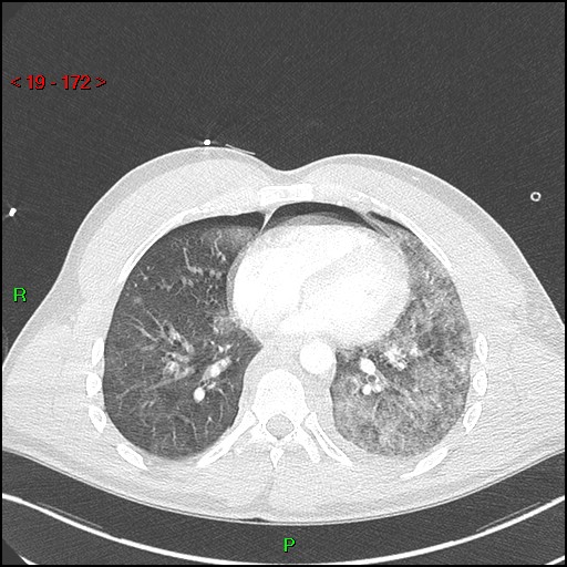Blunt thoracic trauma (Radiopaedia 73454-84221 Axial lung window 64).jpg