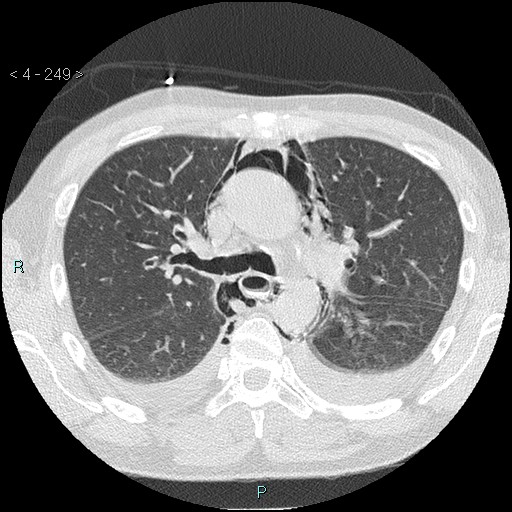 File:Boerhaave syndrome (Radiopaedia 27683-27897 lung window 10).jpg