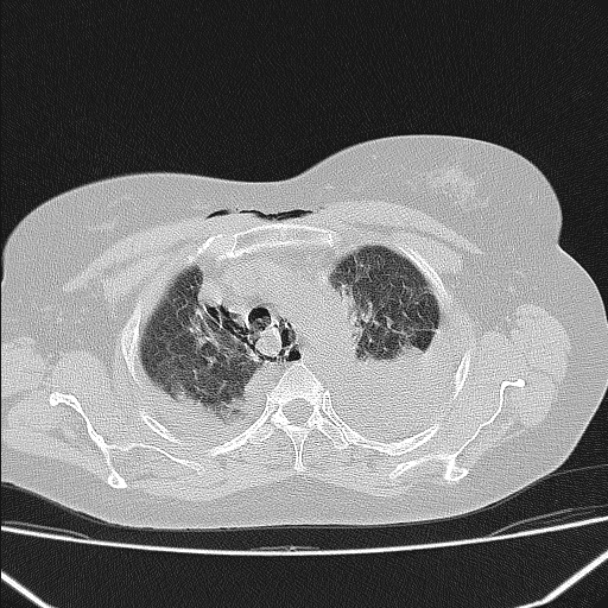Boerhaave syndrome (Radiopaedia 45644-49799 Axial lung window 42).jpg