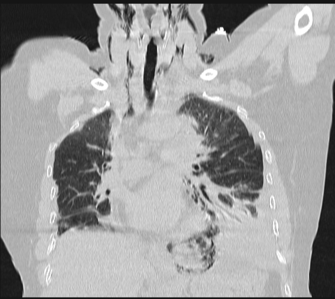 Boerhaave syndrome (Radiopaedia 45644-49799 Coronal lung window 33).jpg