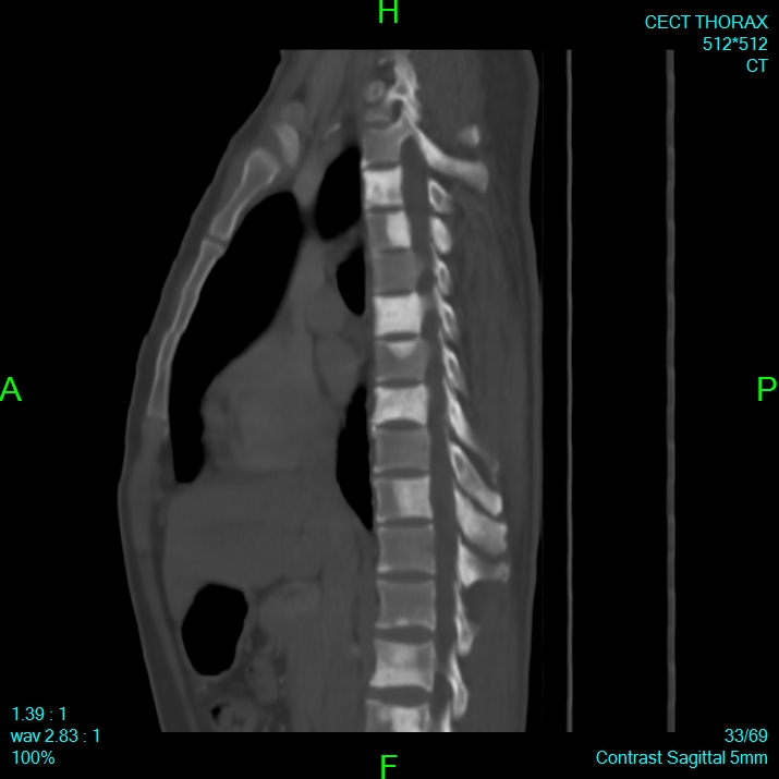 Bone metastases from lung carcinoma (Radiopaedia 54703-60937 Sagittal bone window 33).jpg
