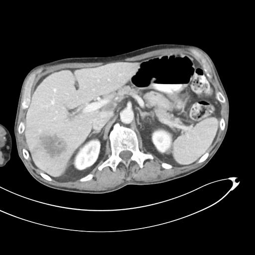 Bone metastasis from squamous cell carcinoma (Radiopaedia 30133-30730 B 21).jpg
