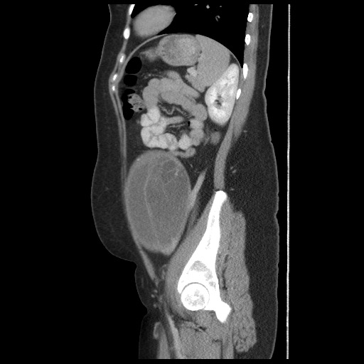 File:Borderline mucinous tumor (ovary) (Radiopaedia 78228-90808 B 49).jpg