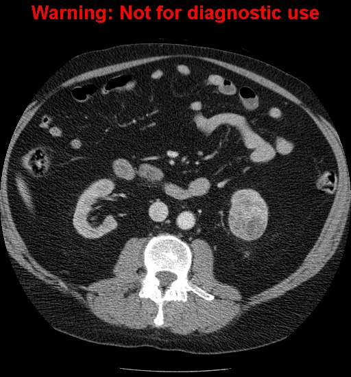 File:Bosniak renal cyst - type IV (Radiopaedia 23402-23466 D 34).jpg