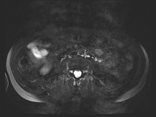 File:Bouveret syndrome (Radiopaedia 61017-68856 Axial MRCP 47).jpg
