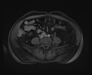 File:Bouveret syndrome (Radiopaedia 61017-68856 Axial T1 C+ fat sat 66).jpg