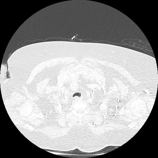 Bovine aortic arch - right internal mammary vein drains into the superior vena cava (Radiopaedia 63296-71875 Axial lung window 18).jpg