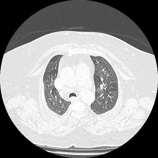 Bovine aortic arch - right internal mammary vein drains into the superior vena cava (Radiopaedia 63296-71875 Axial lung window 46).jpg