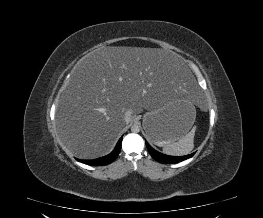 Bowel and splenic infarcts in acute lymphocytic leukemia (Radiopaedia 61055-68913 A 34).jpg