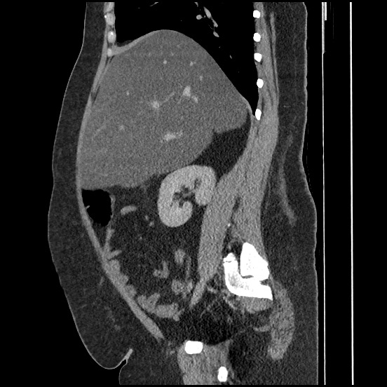 Bowel and splenic infarcts in acute lymphocytic leukemia (Radiopaedia 61055-68913 C 50).jpg