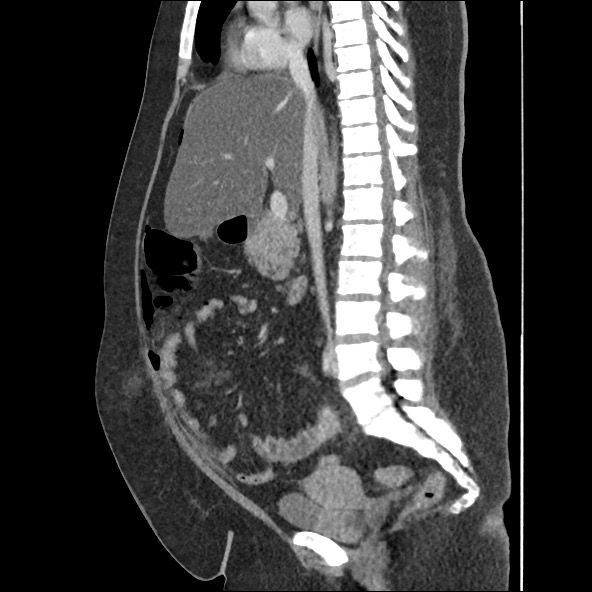 Bowel and splenic infarcts in acute lymphocytic leukemia (Radiopaedia 61055-68915 C 37).jpg