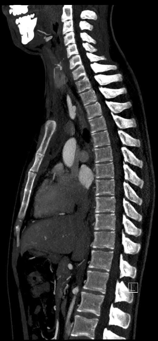 Brachiocephalic trunk pseudoaneurysm (Radiopaedia 70978-81191 C 47).jpg