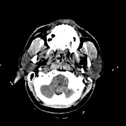 File:Brain contusions, internal carotid artery dissection and base of skull fracture (Radiopaedia 34089-35339 Axial non-contrast 16).png