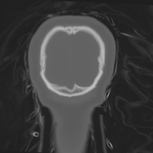 File:Brain contusions, internal carotid artery dissection and base of skull fracture (Radiopaedia 34089-35339 Coronal bone window 65).png