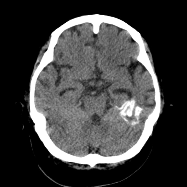 Brain cortical laminar necrosis (Radiopaedia 25822-25971 Axial non-contrast 15).jpg