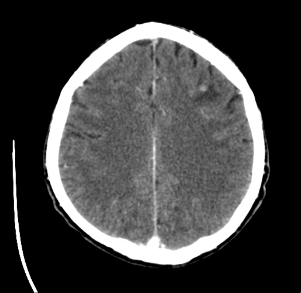 File:Brain metastases from lung cancer (Radiopaedia 24480-24781 Axial C+ delayed 43).jpg