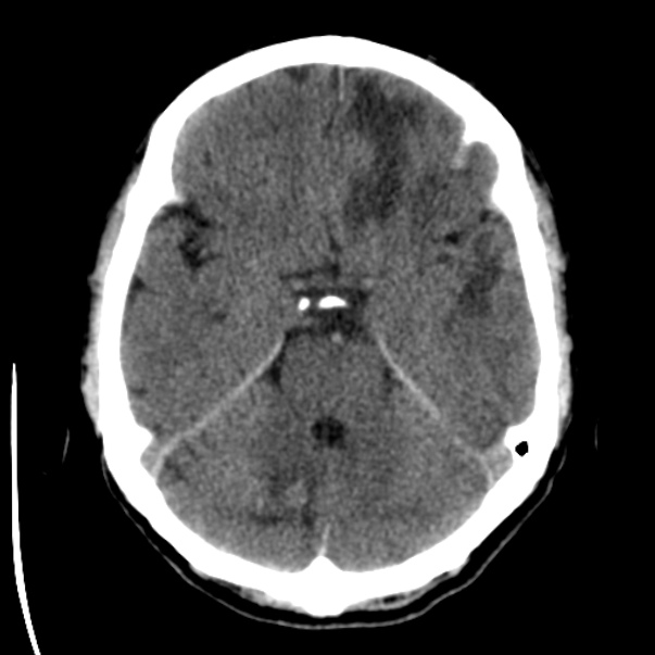Brain metastases from lung cancer (Radiopaedia 24480-24781 Axial non-contrast 14).jpg