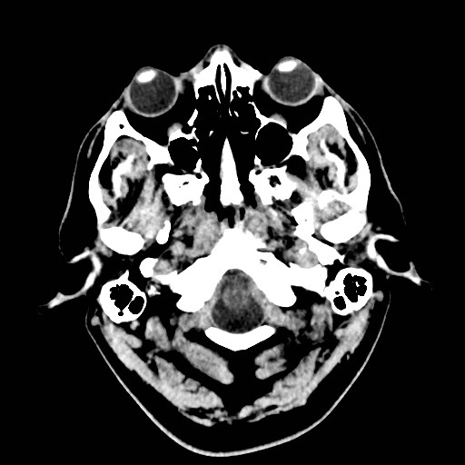File:Brain metastases from lung cancer (Radiopaedia 83839-99027 Axial non-contrast 2).jpg