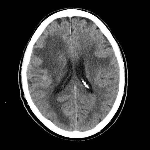 File:Brain metastases from lung cancer (Radiopaedia 83839-99027 Axial non-contrast 21).jpg