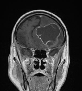 File:Brain metastasis (lung cancer) (Radiopaedia 48289-53179 Coronal T1 C+ 24).png