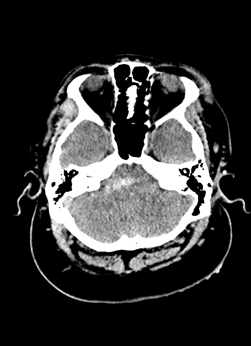 Brainstem hemorrhage (Radiopaedia 81294-94976 Axial non-contrast 48).jpg