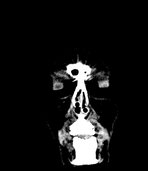 Brainstem hemorrhage (Radiopaedia 81294-94976 Coronal non-contrast 2).jpg