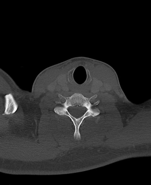Branchial cleft cyst (Radiopaedia 31167-31875 Axial bone window 53).jpg