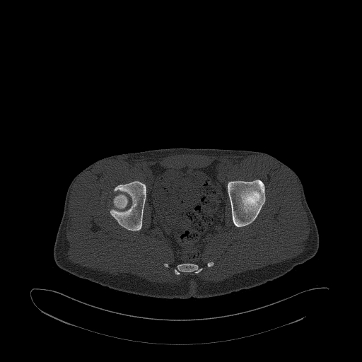 Brodie abscess- femoral neck (Radiopaedia 53862-59966 Axial bone window 122).jpg
