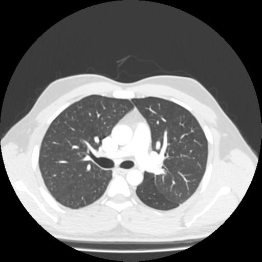 Bronchial carcinoid (Radiopaedia 80013-93291 Axial lung window 42).jpg